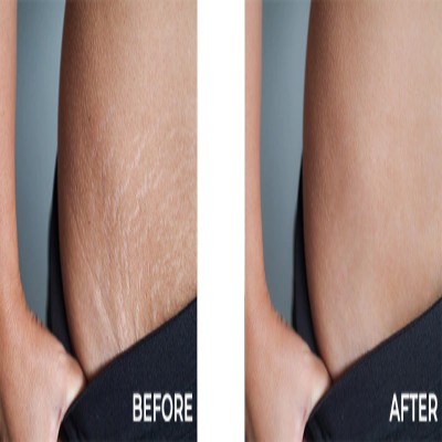 Electrocautery & Radiocautery
