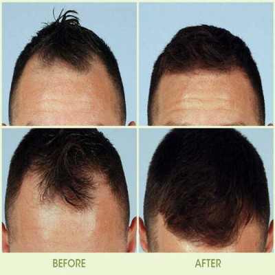 Electrocautery & Radiocautery